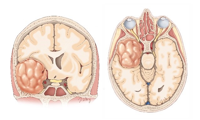 Опухоль головного мозга: особенности реабилитации после операции