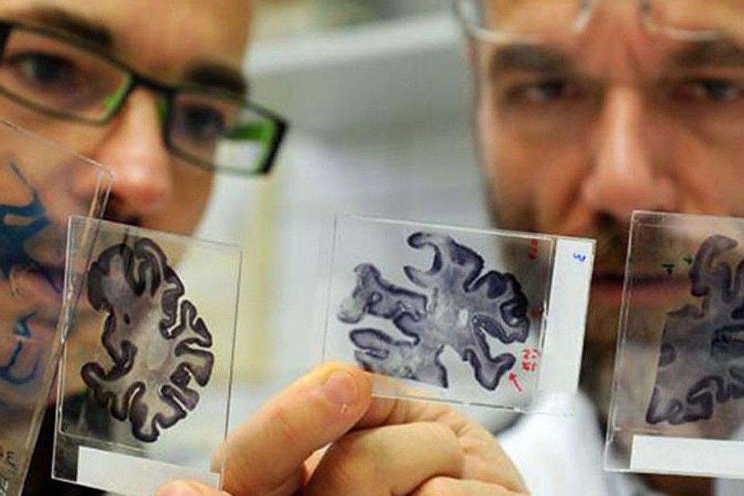 Одна из причин деменции - атеросклероз сосудов головного мозга. Фото: GLOBAL LOOK PRESS